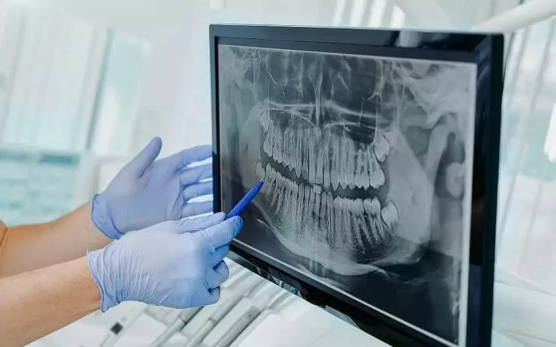 Какие анализы нужно сдать перед имплантацией зубов