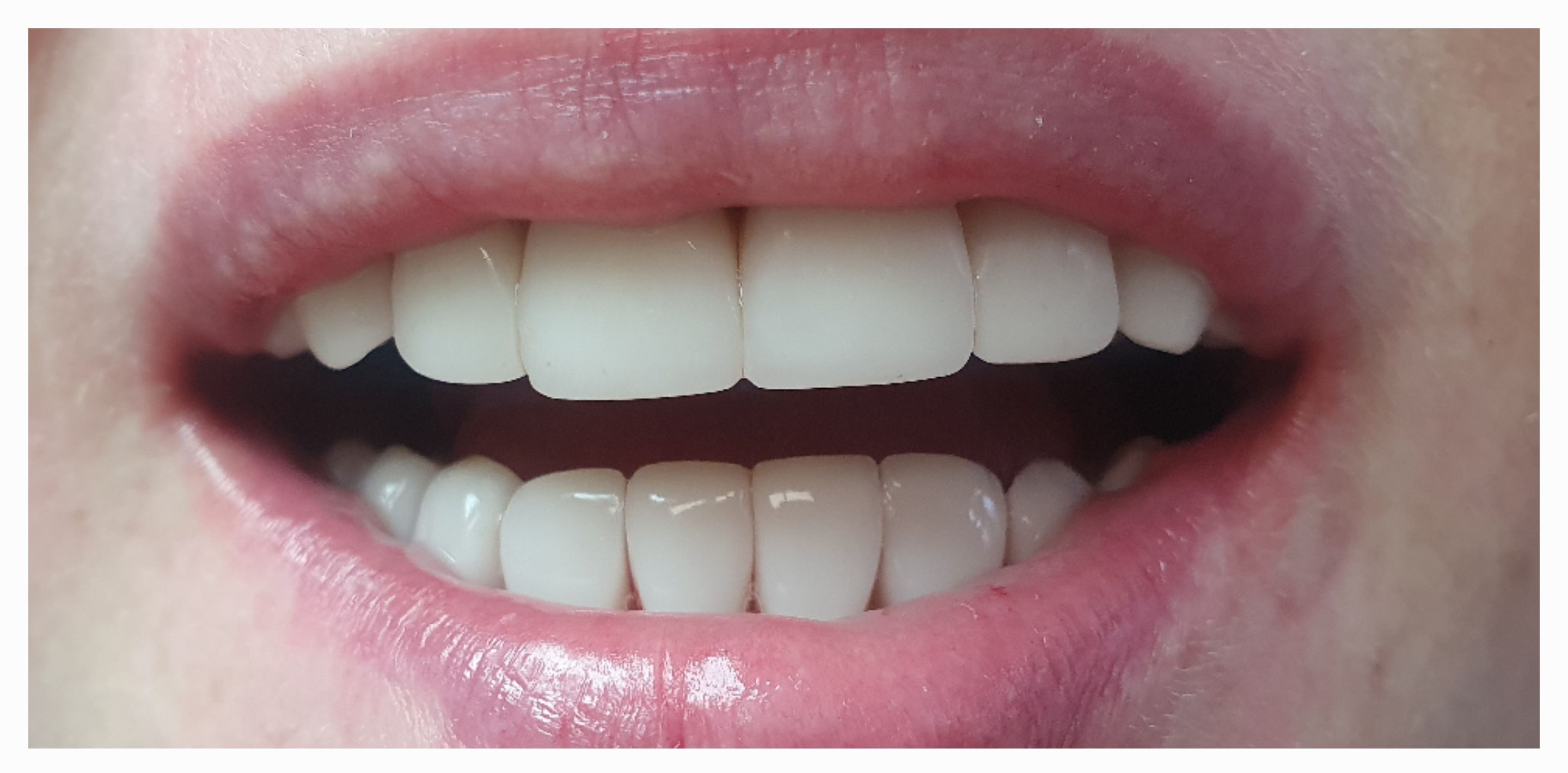 Композитные виниры