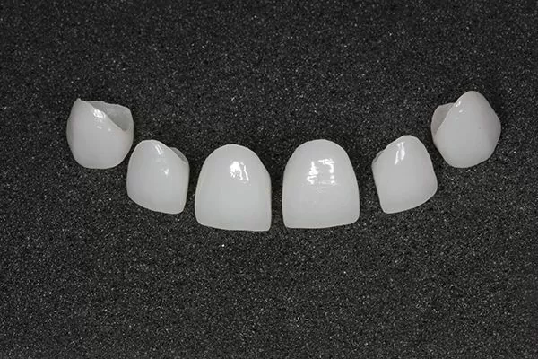 Композитные виниры