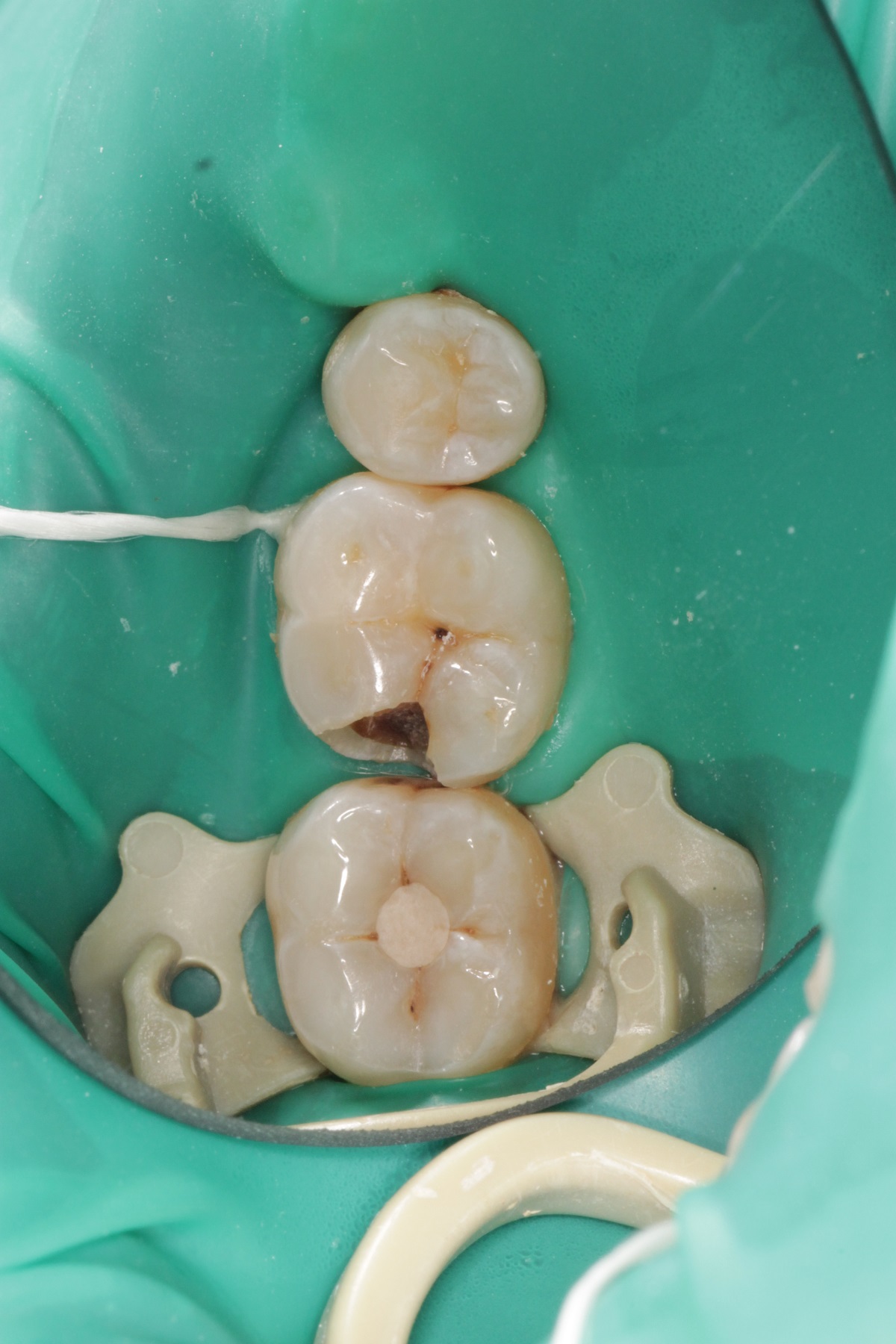 Лечение кариеса