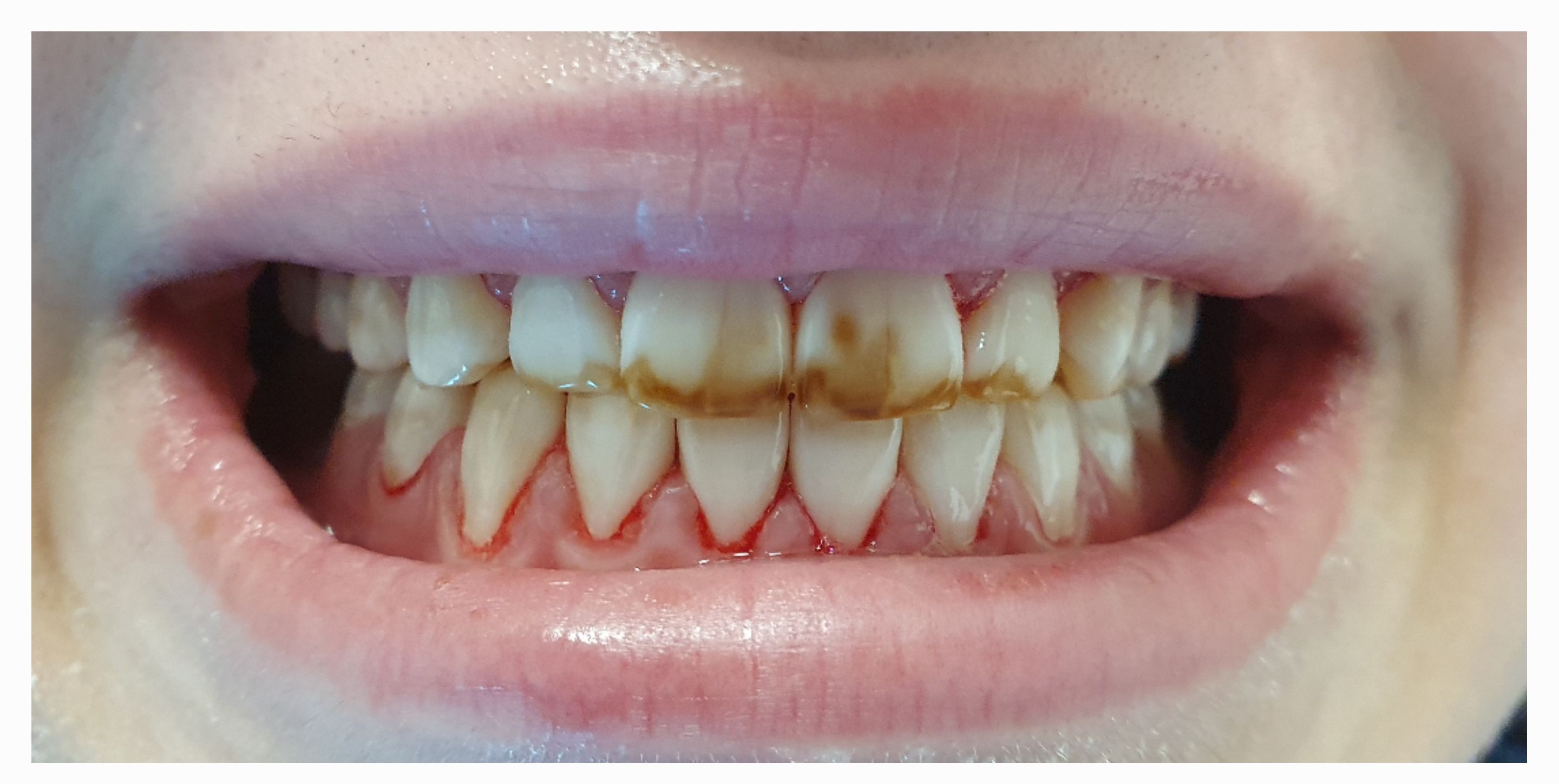 Композитные виниры