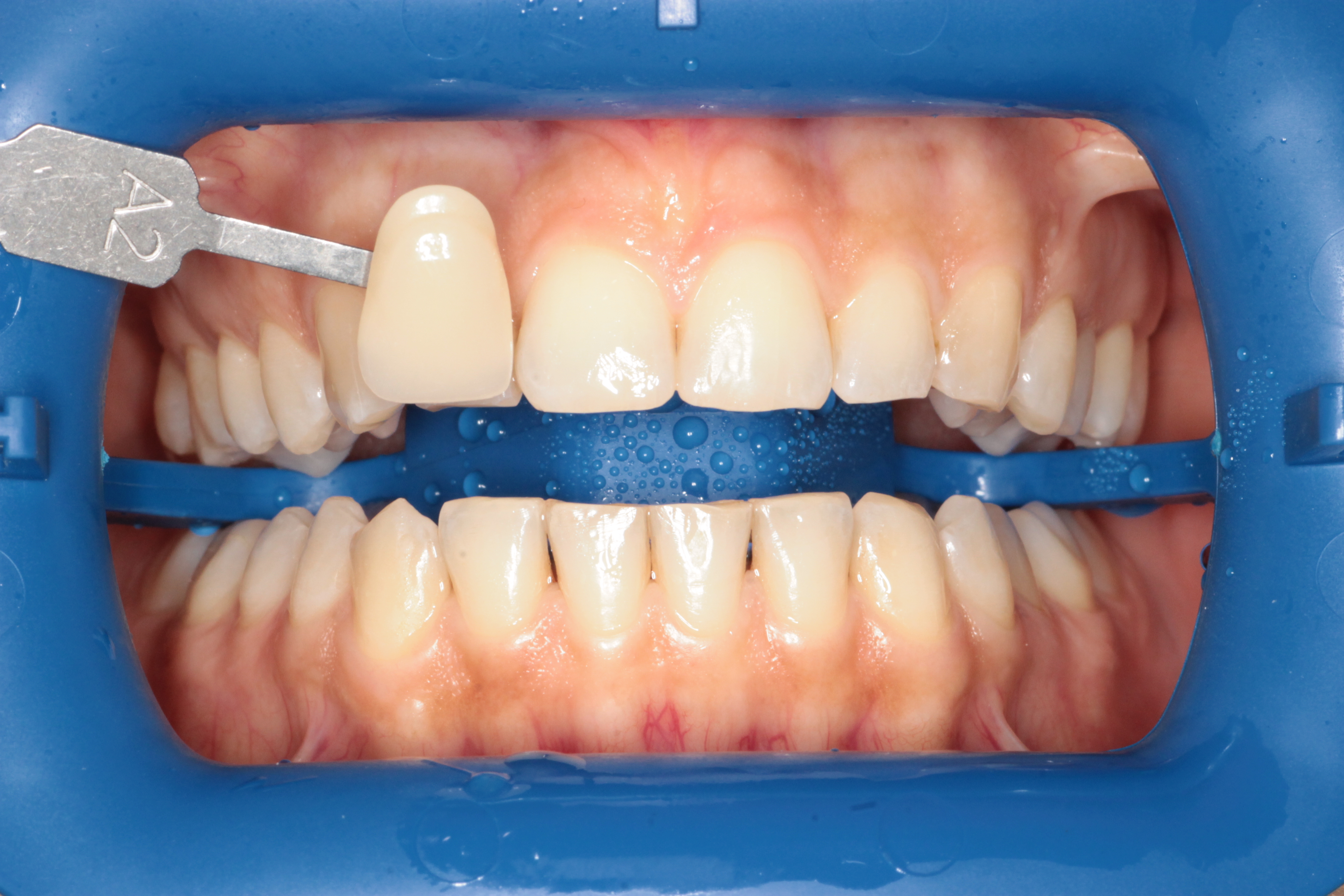 Отбеливание