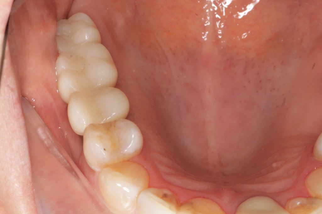 Имплантация зубов