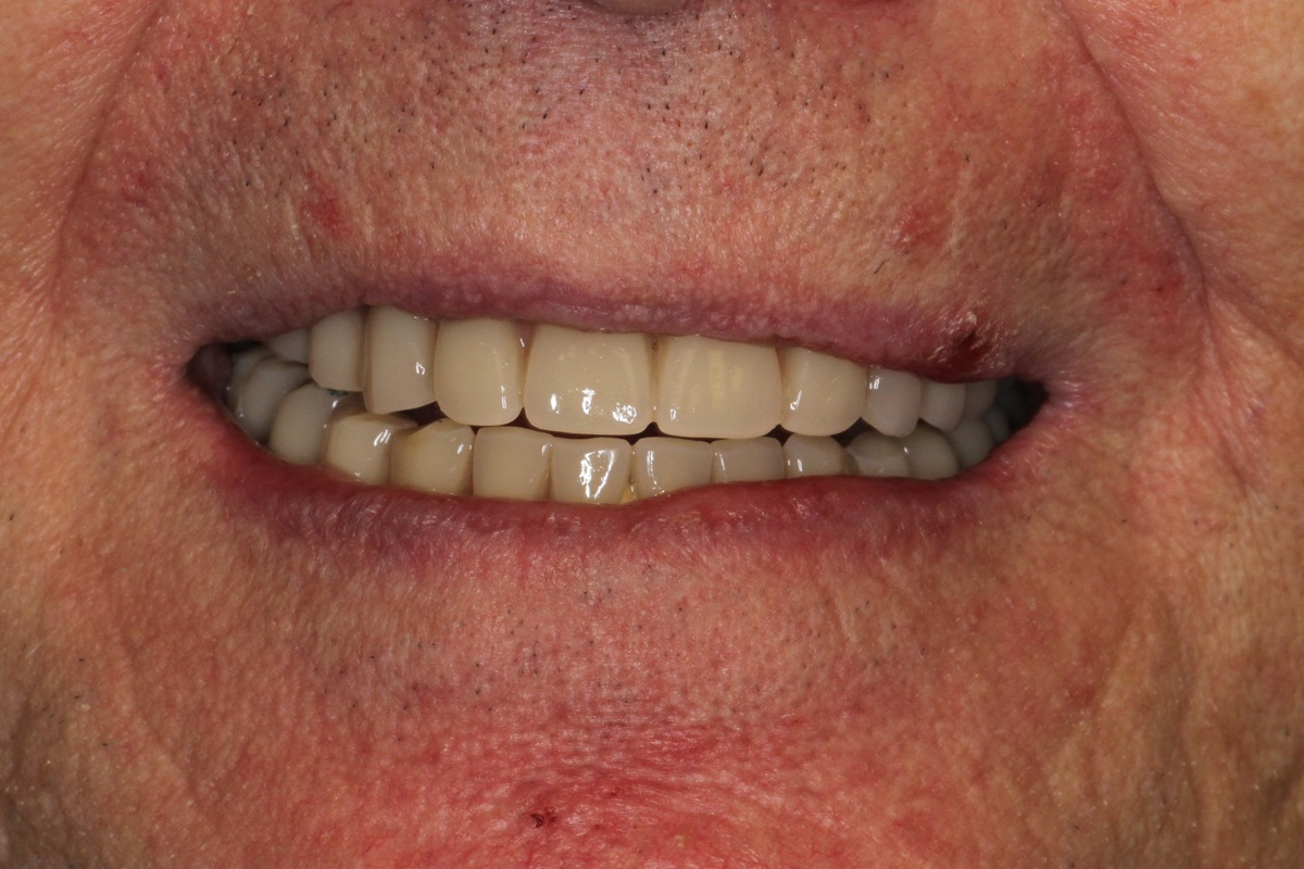 Восстановление верхней и нижней челюсти по системе All-on-6