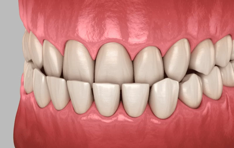 Мезиальный прикус: причины развития, виды, методы коррекции