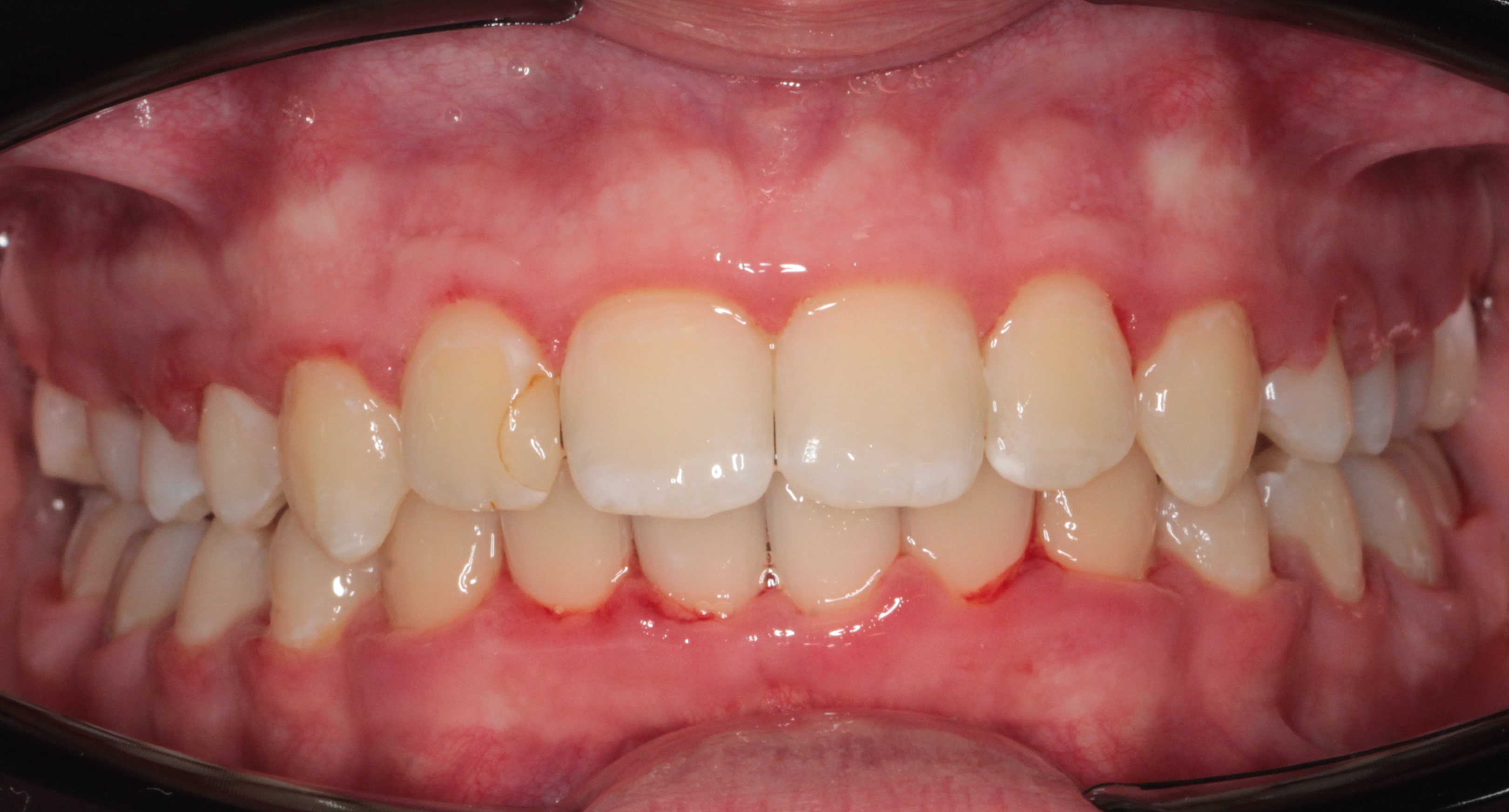 Исправление прикуса брекетами