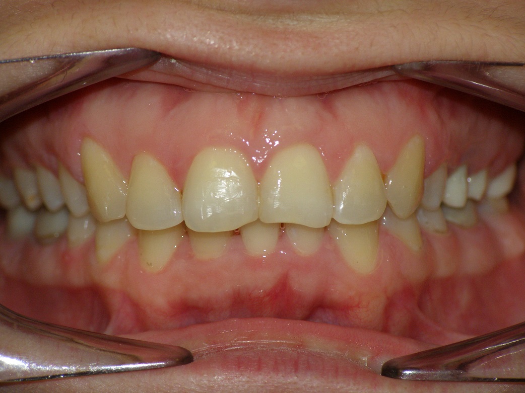 Исправление прикуса