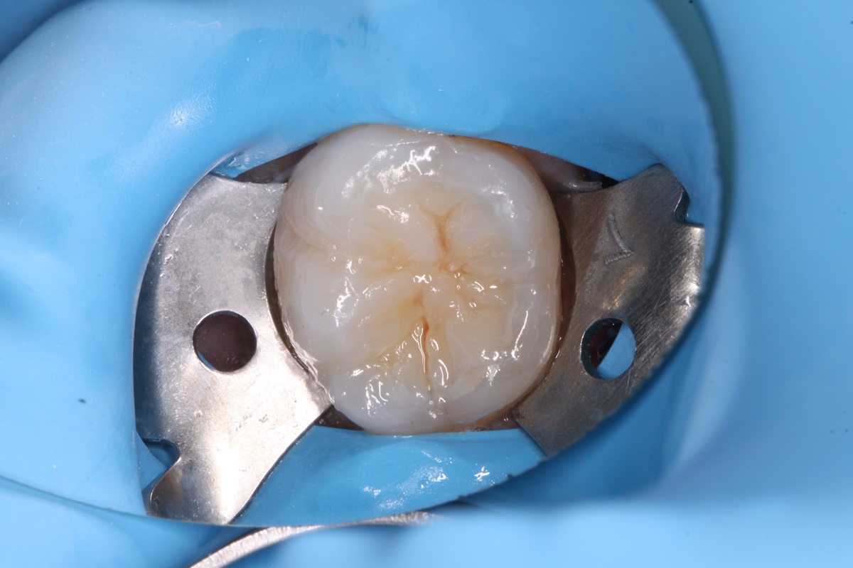 Лечение кариеса