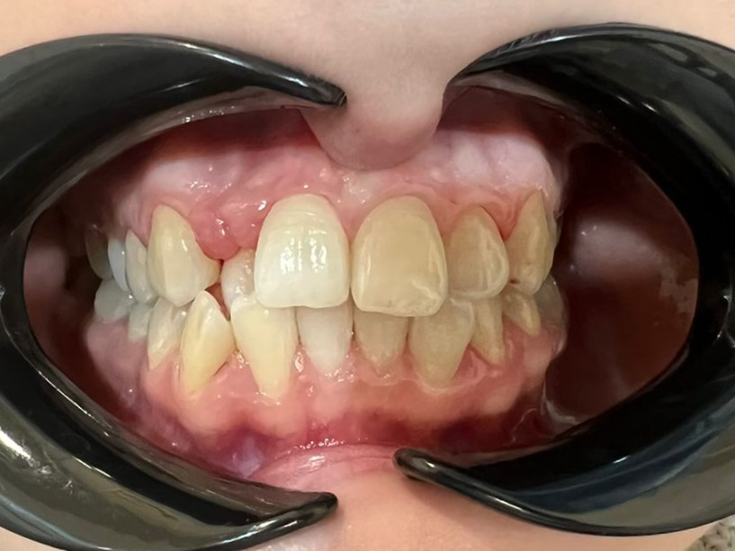 Исправление прикуса брекетами