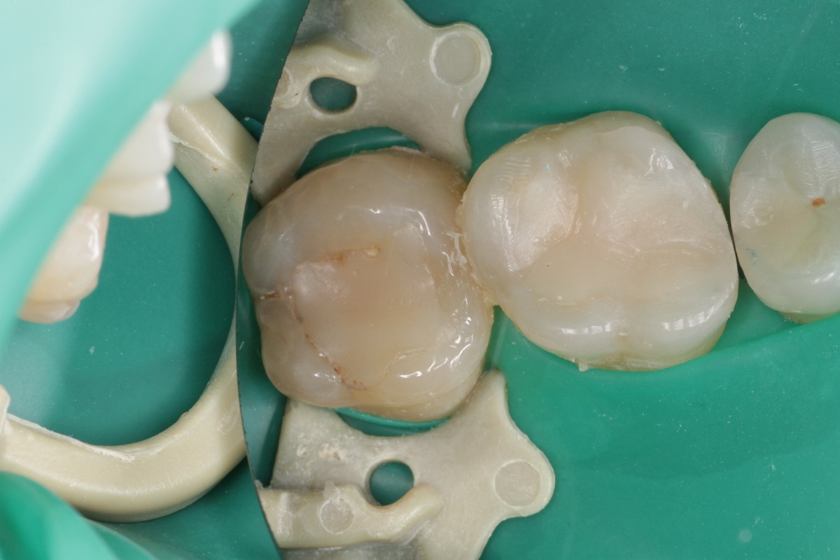 Лечение кариеса