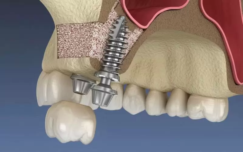 Как наращивают костную ткань для имплантации зуба