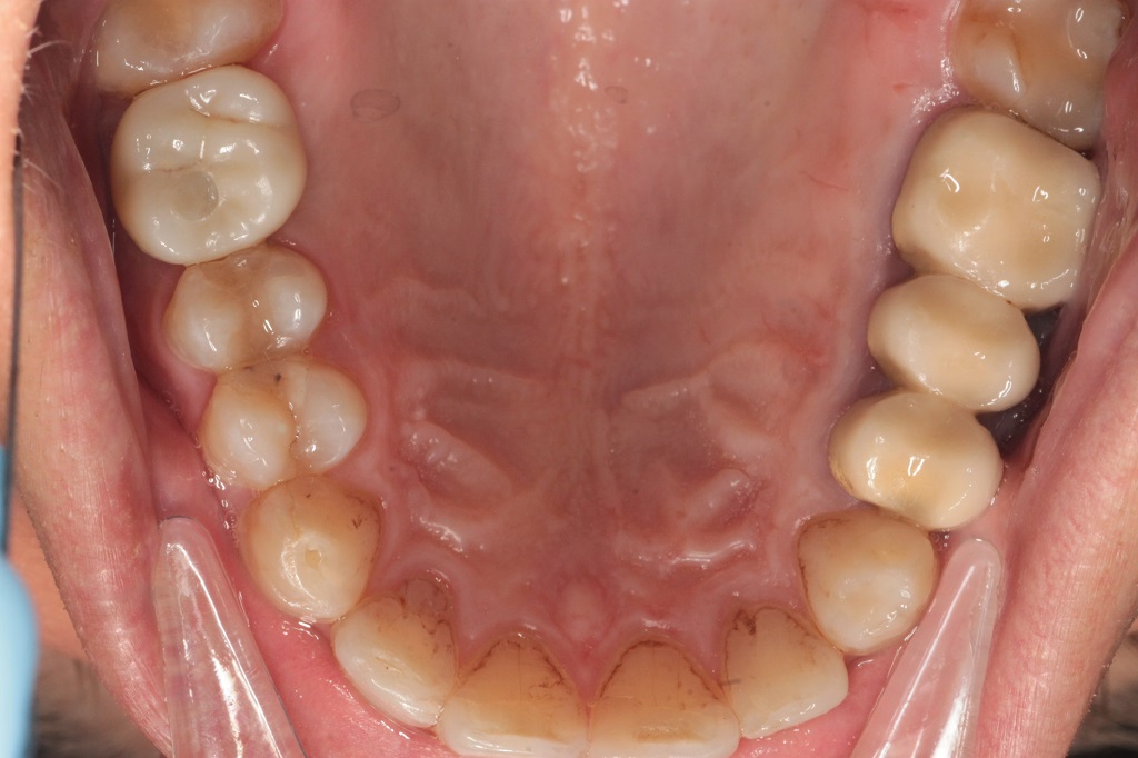 Имплантация зуба