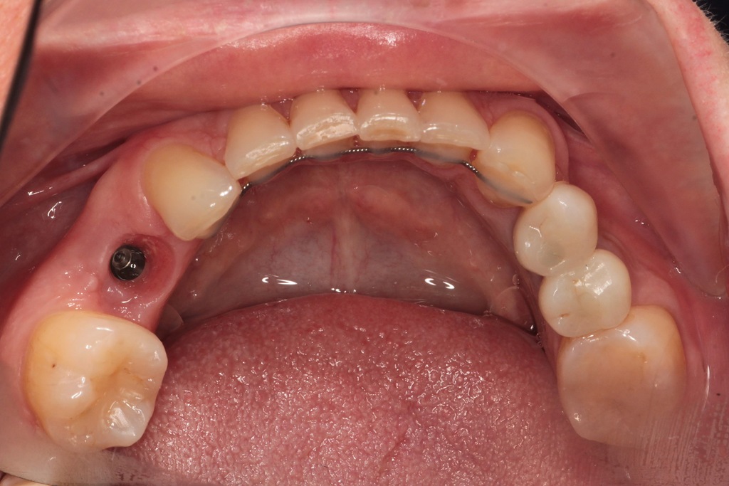 Имплантация зуба в зоне улыбки