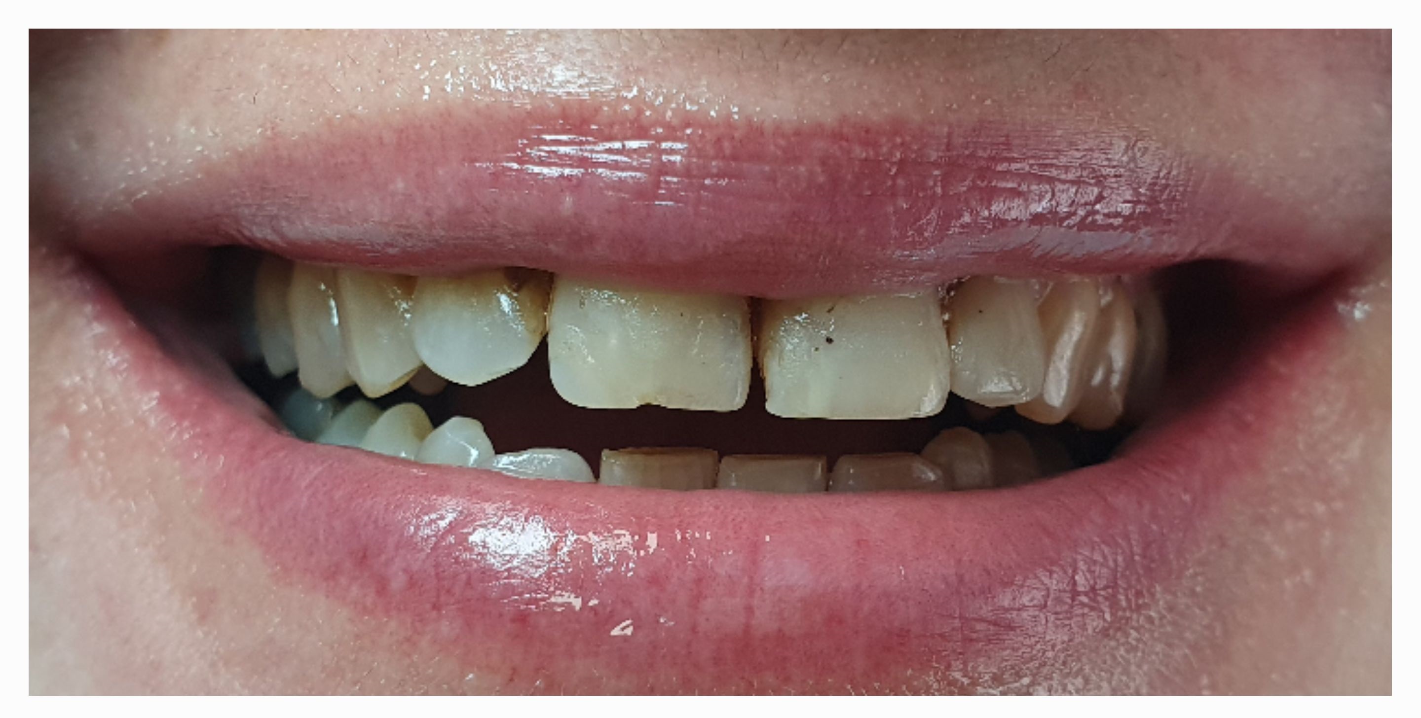 Композитные виниры