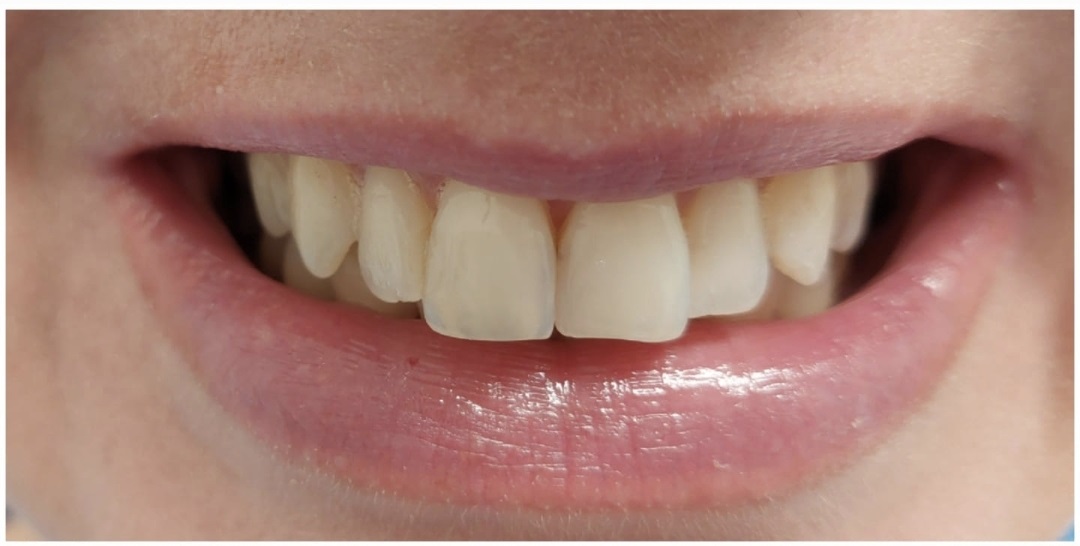 Композитные виниры