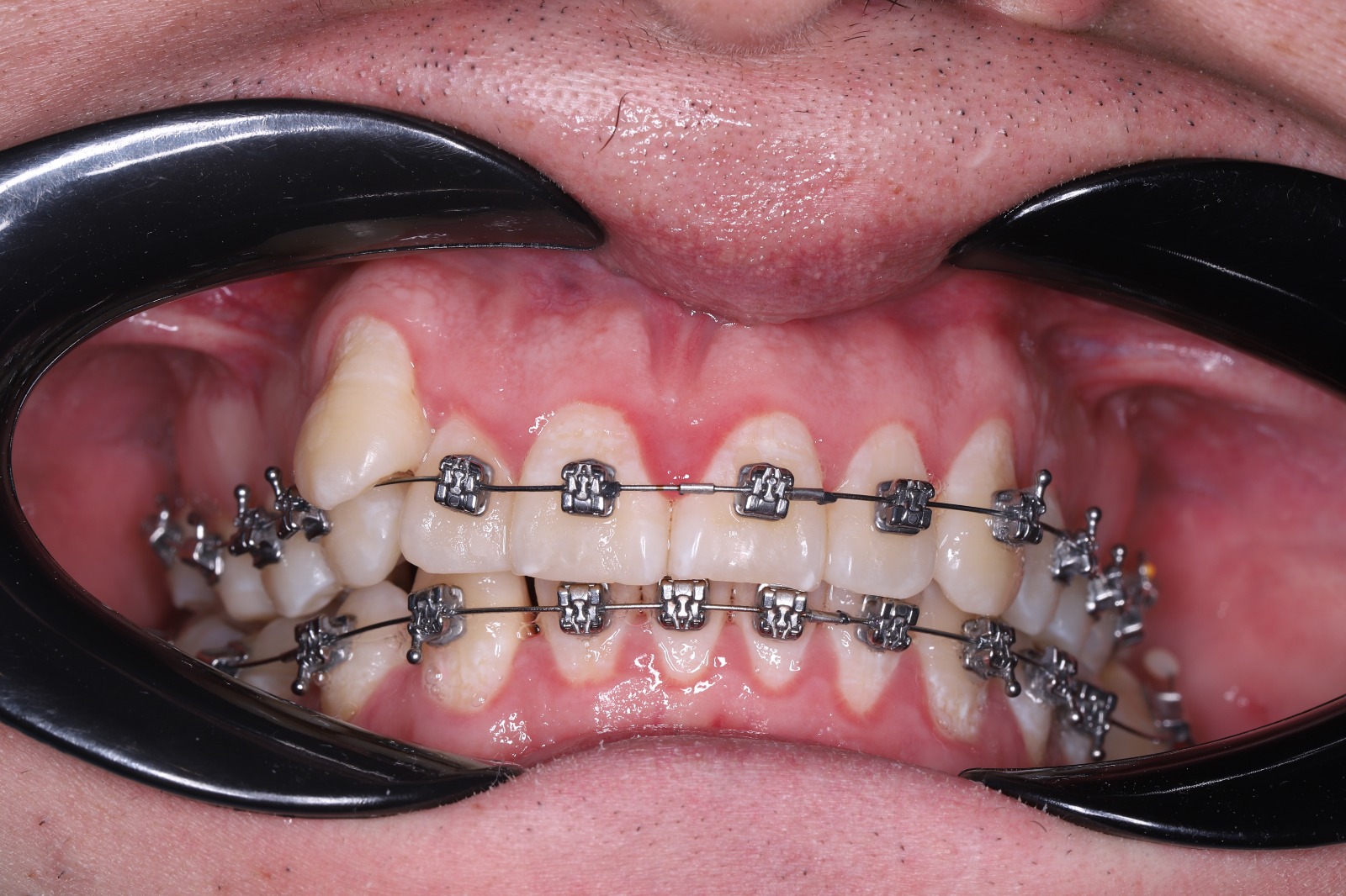 Лечение гингивита